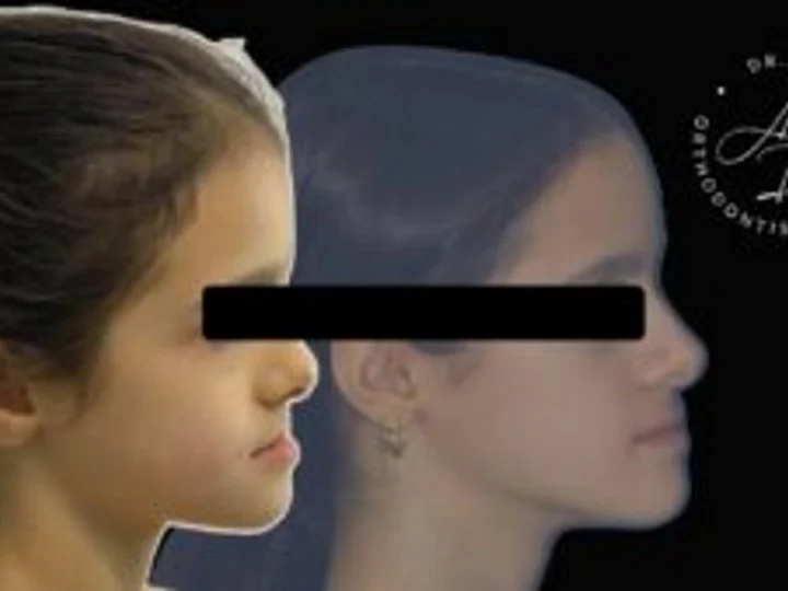 Nje Rast Komplet Ortodonci